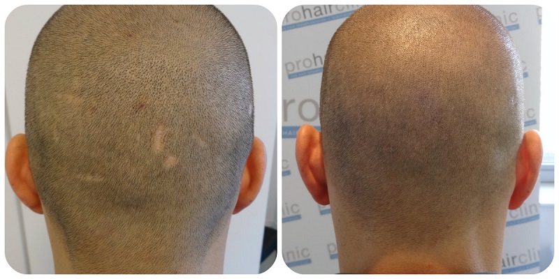 scar improvement using Tricopigmentation
